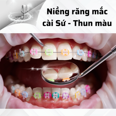 Niềng răng mắc cài sứ và thun màu