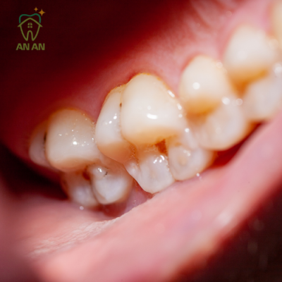 Răng sâu cần được trám