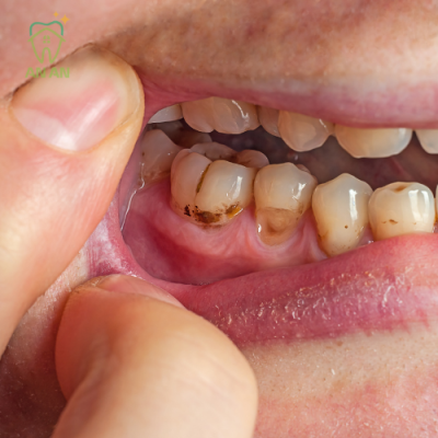 Răng sâu cần được trám lại