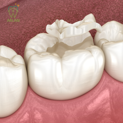 Hình ảnh mô phỏng trám răng