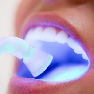 Trám răng thẩm mỹ tại nha khoa