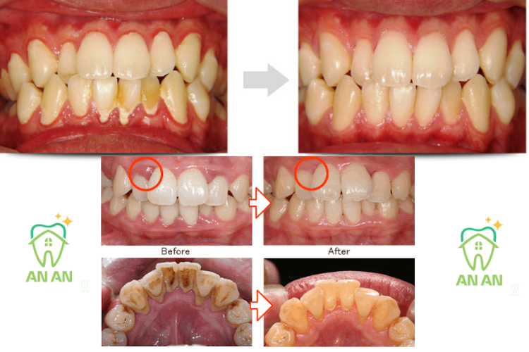 Hình ảnh trước và sau khi cạo vôi răng tại quận 8 ở Nha khoa An An