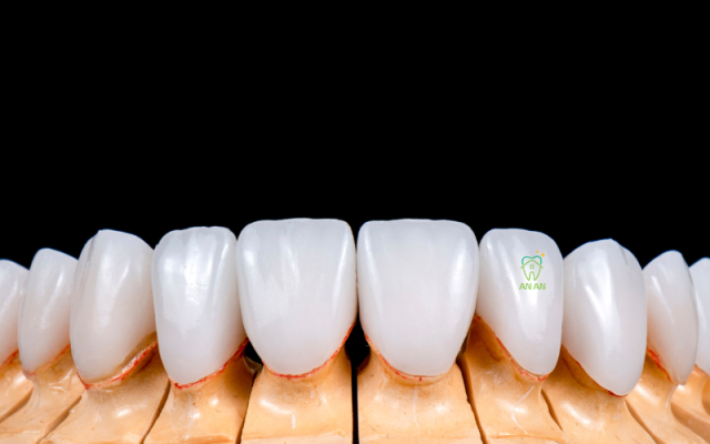 Răng sứ sau khi hoàn thiện trong labo