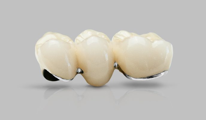 Cầu răng có khung kim loại nâng đỡ