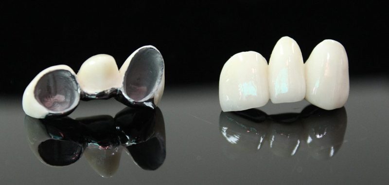 Cầu răng sứ có khung kim loại