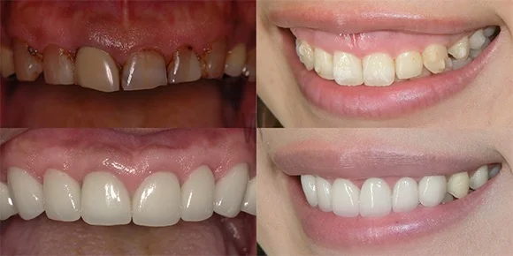 Hình ảnh trước và sau khi làm răng sứ thẩm mỹ