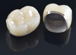 Mão răng sứ có kim loại bên trong