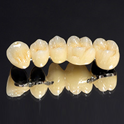 Răng sứ kim loại trông rất giống răng thật