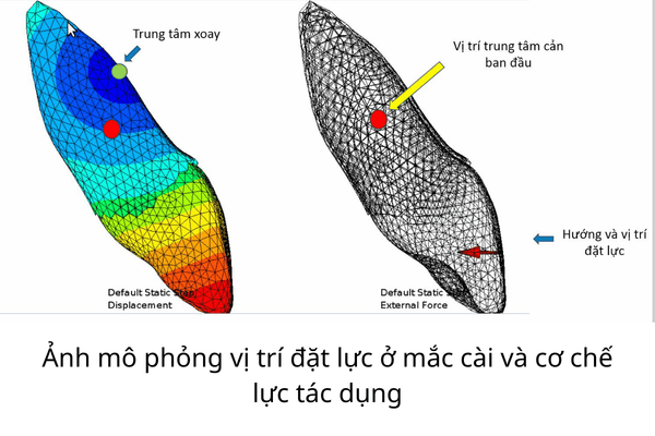 Niềng Răng Mắc Cài Kim Loại Tự Khoá 3 Mô phỏng lực tác dụng ở vị trí đặt mắc cài kim loại tự khoá