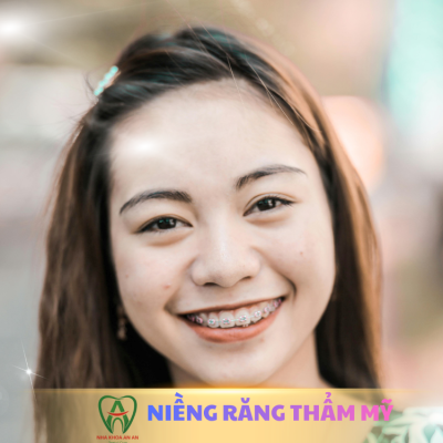 Niềng răng thẩm mỹ - ảnh bìa