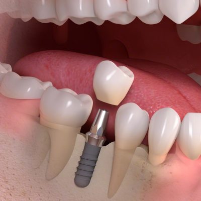 Implant Nha khoa