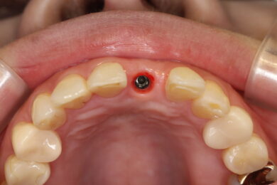 Lành thương sau khi đặt implant