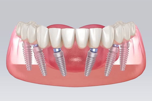 Ảnh mô tả implant All-on -6