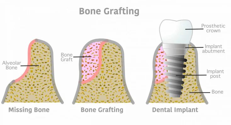 Tăng thể tích xương để lưu giữ implant
