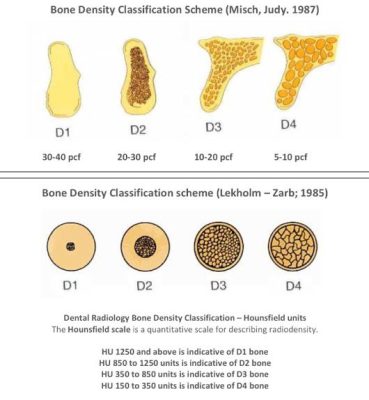Hệ thống phân loại xương để cắm implant