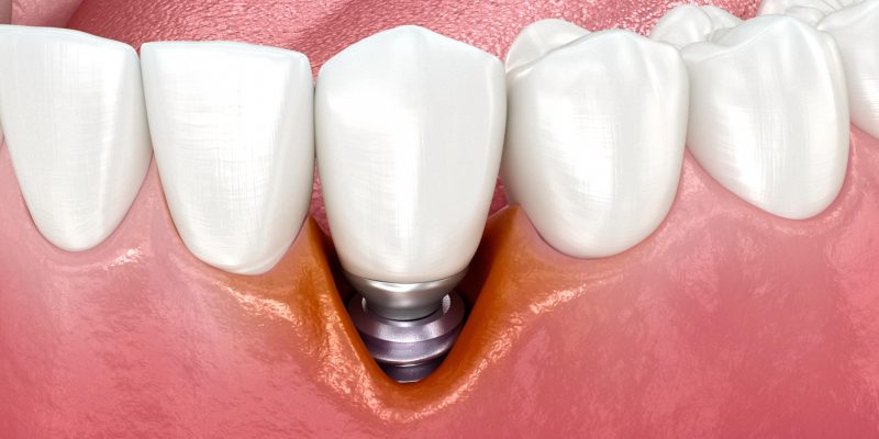 Implant nha khoa bị tụt nướu