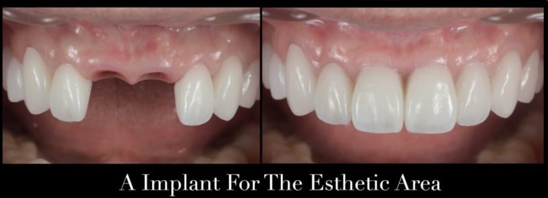 Răng implant có hình dạng và chức năng gần như răng thật