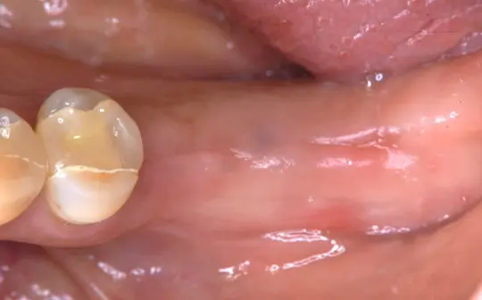Implant nha khoa giúp hạn chế tiêu xương ổ răng