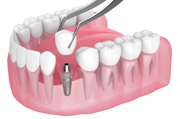 Răng sứ trên implant