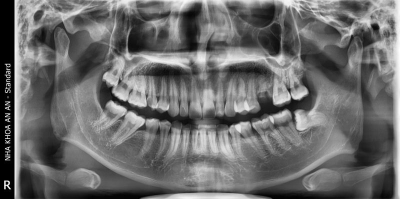 Viêm Tuỷ Răng Cấp – Cách Điều Trị Tuỷ Hiệu Quả 3 Chụp X quang răng trước khi điều trị tuỷ