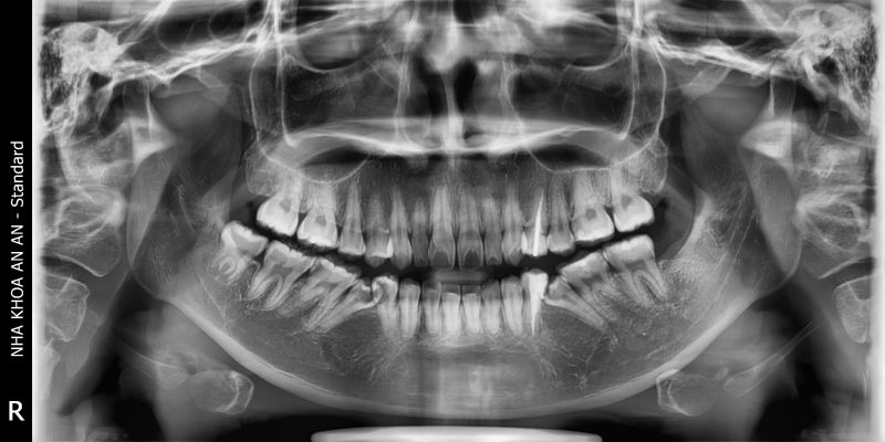 Viêm Tuỷ Răng Cấp – Cách Điều Trị Tuỷ Hiệu Quả 4 Răng 44, 45 sâu răng vỡ lớn cần điều trị tuỷ để giữ lại