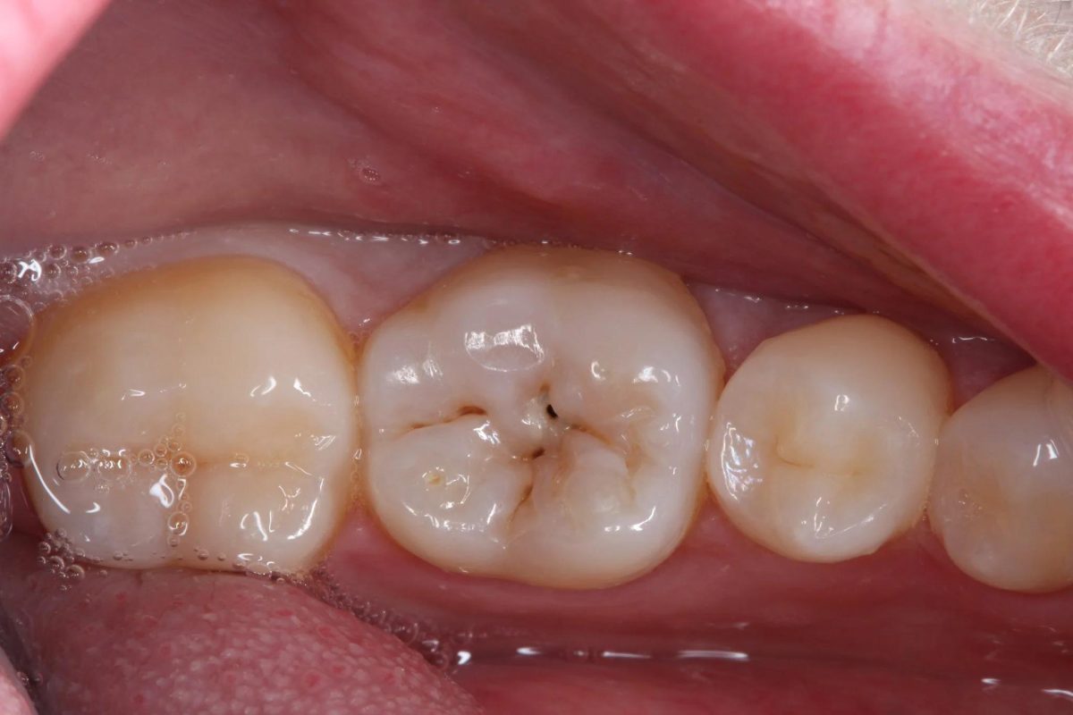 Chi phí trám răng thế nào nếu so với răng sứ
