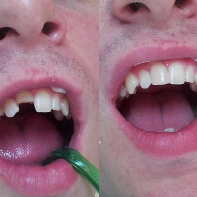 Chi phí trám răng thẩm mỹ thấp hơn bọc răng sứ