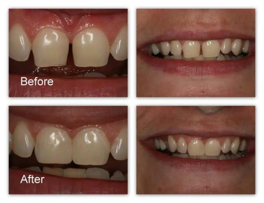 Trám khe thưa răng cửa bằng vật liệu thẩm mỹ