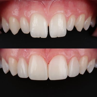 Trám khe thưa răng cửa thẩm mỹ