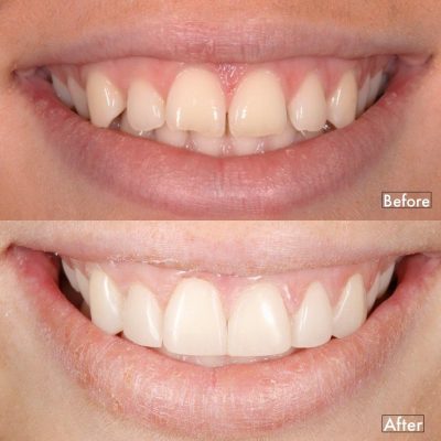 Ảnh trám răng kẽ thưa của khách hàng tại Nha khoa AN AN