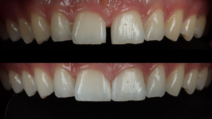Ảnh trước và sau khi trám răng thưa kẽ
