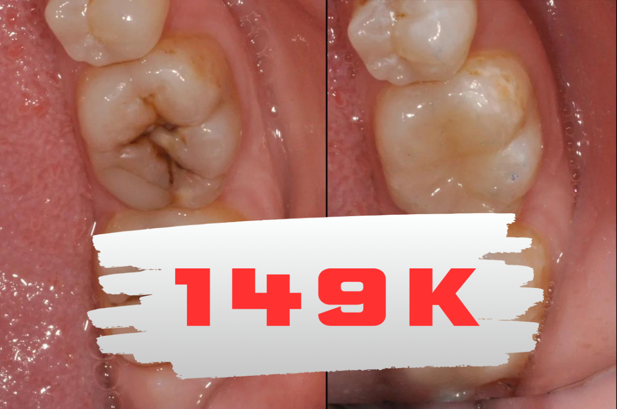 trám răng sâu giá bao nhiêu quận 8