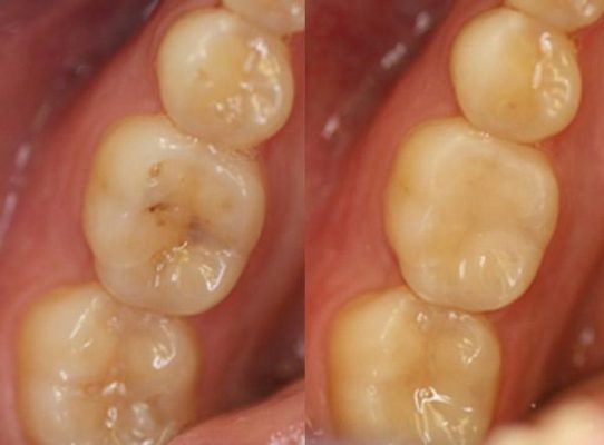 Trám răng sâu giai đoạn đầu giá bao nhiêu?