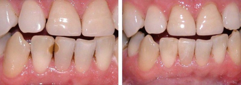 trám răng sâu ở vùng răng cửa
