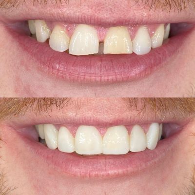 Ảnh trước và sau khi trám răng thưa tại Nha khoa AN AN