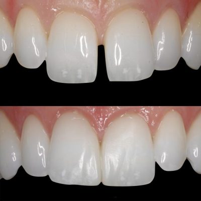 Trám răng thưa kẽ tại Nha khoa An An Quận 8