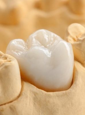 Bọc răng sứ giữ được bao lâu? Bí quyết giúp răng sứ bền đẹp 15–20 năm 7 Ảnh 1 răng sứ sau khi chế tác xong