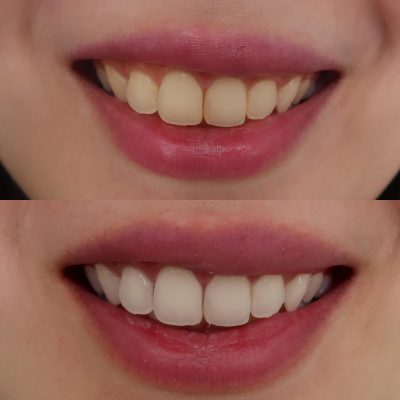 Nha Khoa Tẩy Trắng Răng Uy Tín – Bí Quyết Sở Hữu Hàm Răng Trắng Sáng An Toàn 9 Ảnh khách hàng trước và sau khi tẩy trắng răng tại nha khoa