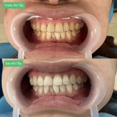 Nha Khoa Tẩy Trắng Răng Uy Tín – Bí Quyết Sở Hữu Hàm Răng Trắng Sáng An Toàn 6 Ảnh trước sau tẩy trắng răng tại nha khoa