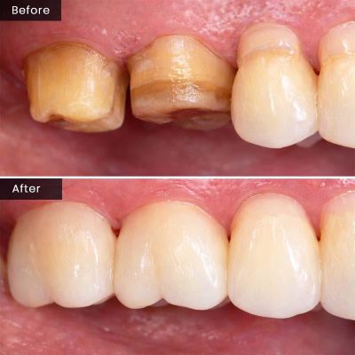 Bọc răng sứ giữ được bao lâu? Bí quyết giúp răng sứ bền đẹp 15–20 năm 2 Ảnh trước và sau khi bọc răng sứ ở vùng răng hàm