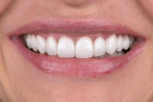 Bọc răng sứ giữ được bao lâu?