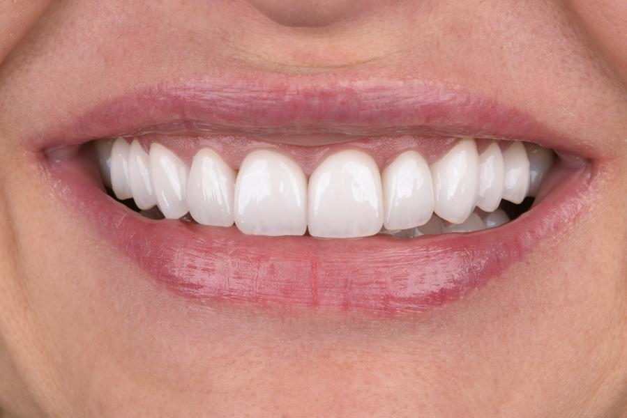 Bọc răng sứ giữ được bao lâu? Bí quyết giúp răng sứ bền đẹp 15–20 năm 1 Bọc răng sứ giữ được bao lâu?