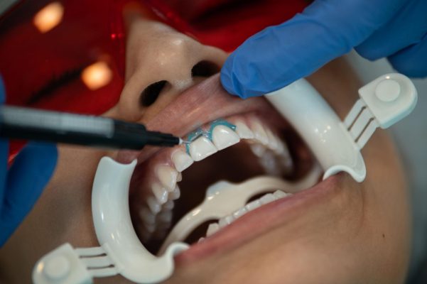 Nha Khoa Tẩy Trắng Răng Uy Tín – Bí Quyết Sở Hữu Hàm Răng Trắng Sáng An Toàn 3 Bôi thuốc thẩy trắng răng tại nha khoa cho khách hàng