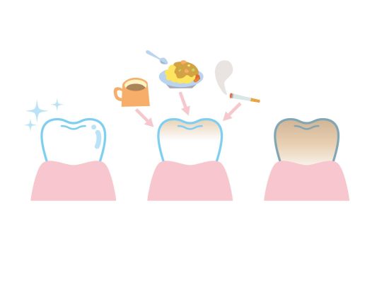 Nha Khoa Tẩy Trắng Răng Uy Tín – Bí Quyết Sở Hữu Hàm Răng Trắng Sáng An Toàn 4 Sau khi tẩy trắng răng nên kiêng gì?