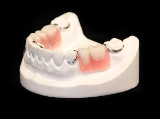 Hàm giả tháo lắp khung kim loại - Nha khoa An An Quận 8