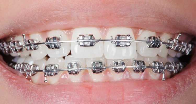 Mắc cài kim loại quận 8 tại Nha khoa An An