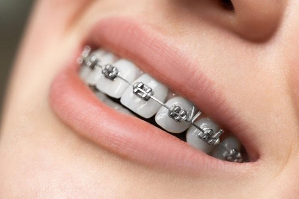 Ưu điểm niềng răng mắc cài kim loại quận 8