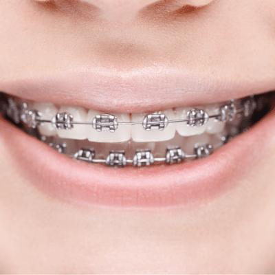 Niềng răng mắc cài kim loại quận 8
