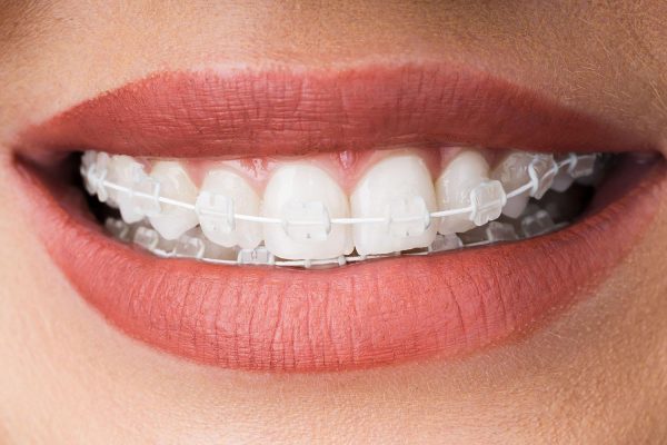 Niềng răng mắc cài sứ quận 8