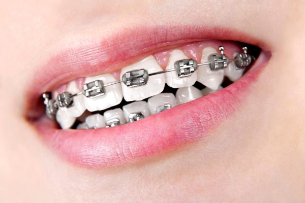 Niềng răng quận 8 mắc cài kim loại